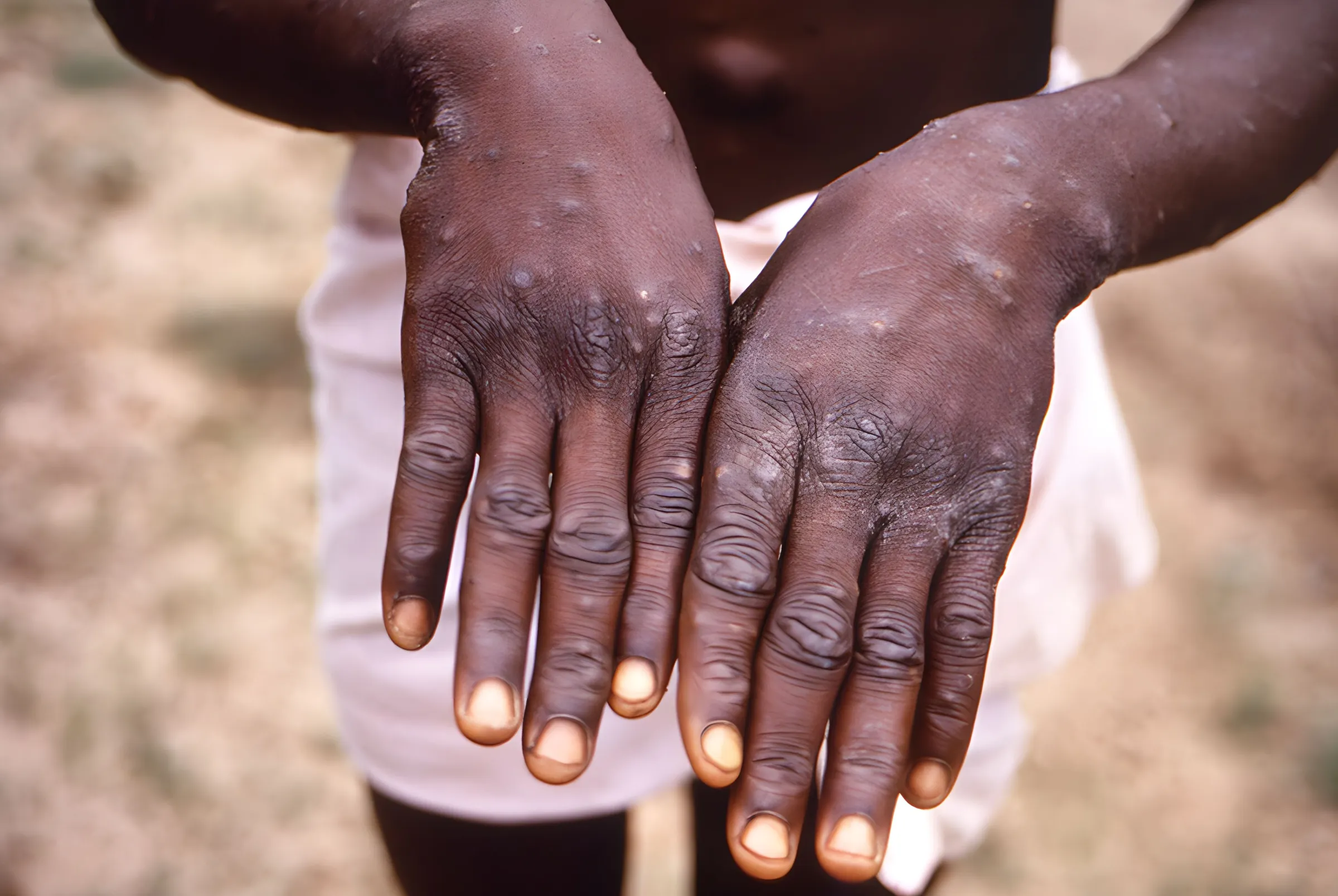 Mpox not new Covid and can be stopped, expert says